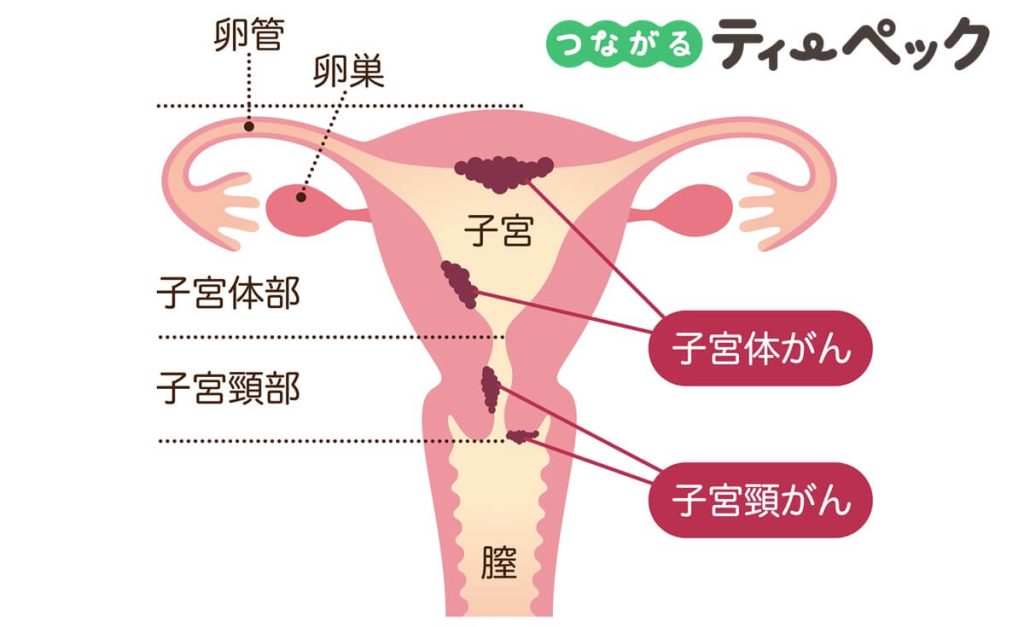 子宮体がんと子宮頸がんを説明するイラスト